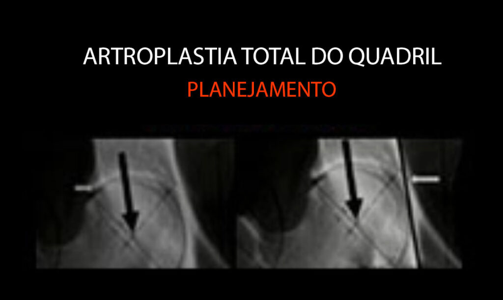 Planejamento na Artroplastia Total do Quadril